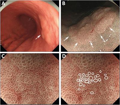 Case report: A rare case of very well-differentiated gastric adenocarcinoma of gastric type with a lymphovascular invasion